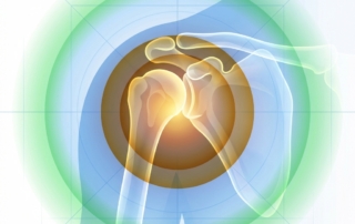 Stylized illustration of shoulder joint stages representing frozen shoulder PRP injection treatment progression